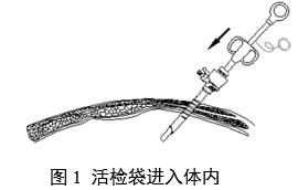 一次性使用內窺鏡用活檢袋注冊審查指導原則（2025年第20號）(圖1)