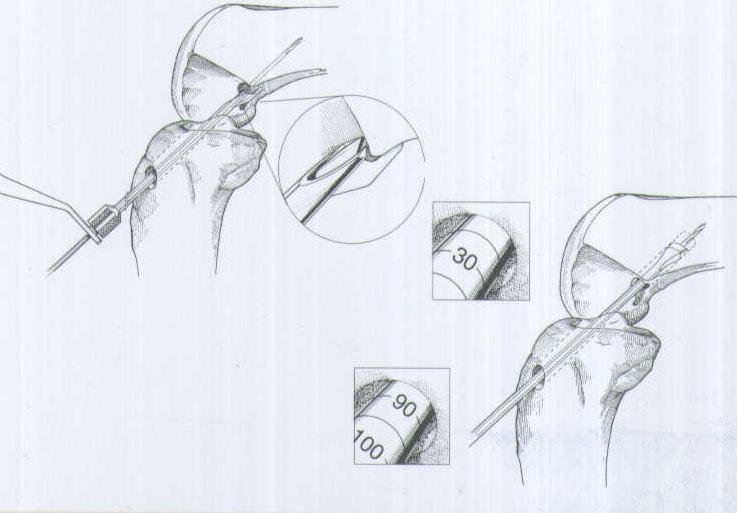 肌腱韌帶固定系統(tǒng)注冊技術(shù)審查指導原則（2020年第36號）