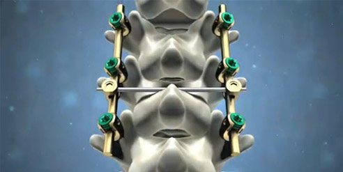 脊柱后路內固定系統(tǒng)注冊技術審查指導原則（2016年第70號）(圖1)